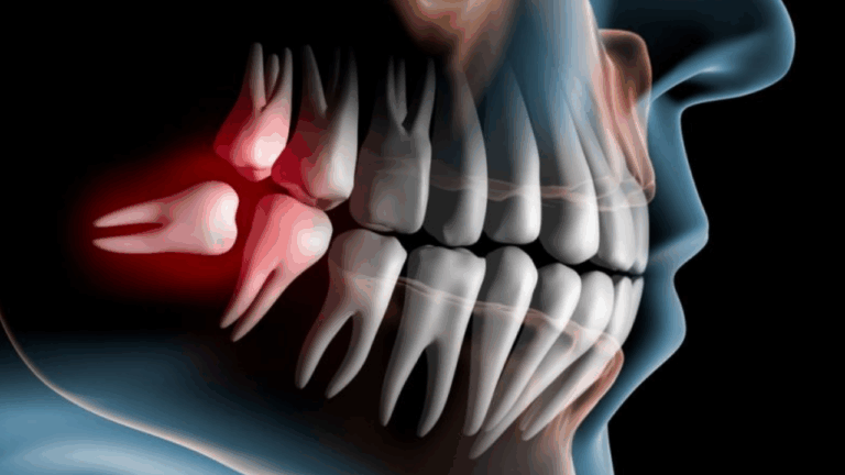 dente do siso, lifestyle, curiosidades, dente, dentista, pesquisa